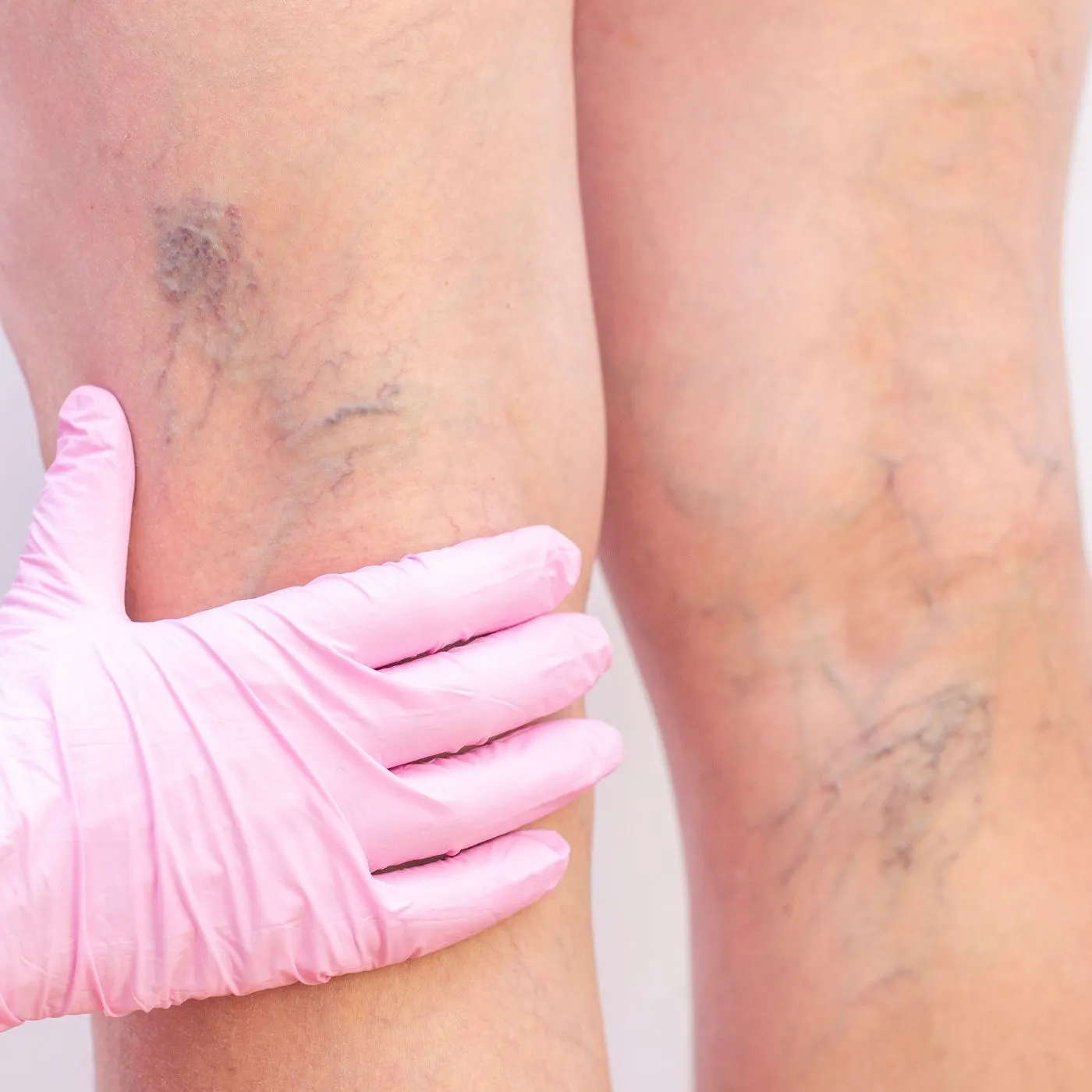 Comment limiter l’apparition des varices ?