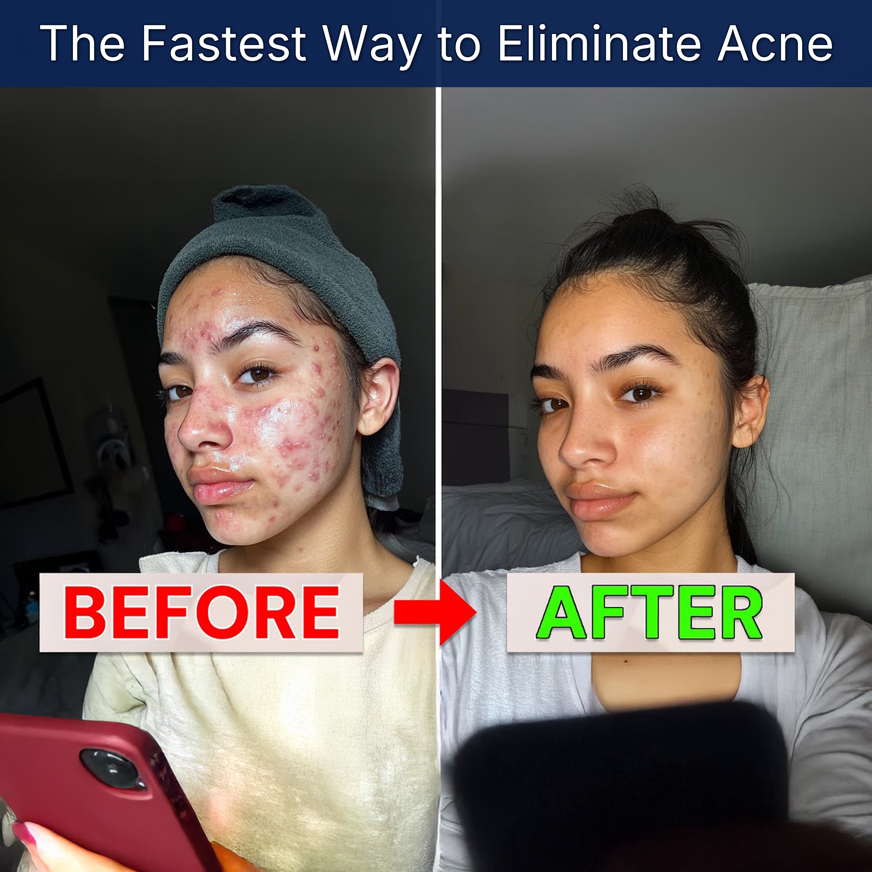The Fastest Way to Eliminate Acne