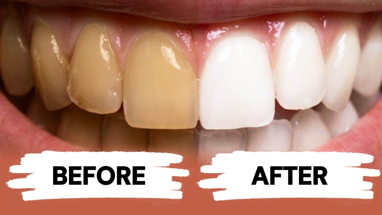 Teeth Whitening at Home episode artwork