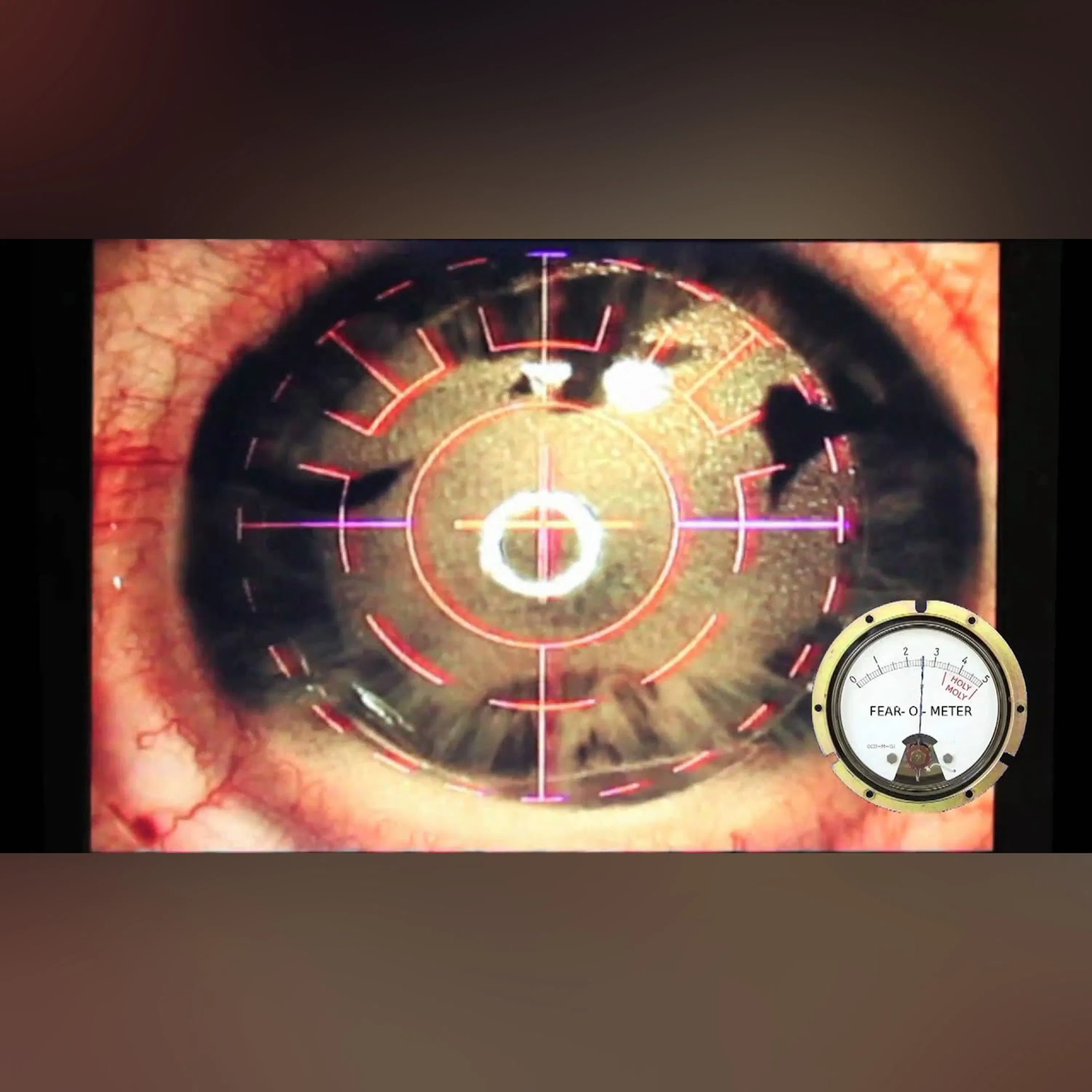 Intralase LASIK Procedure with Fear-o-meter and Pain-o-meter