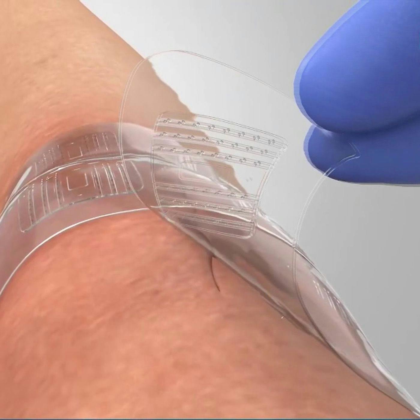 Bandgrip vs Sutures: the Evolution of Ways to Close Incisions, with Fred Smith from BandGrip