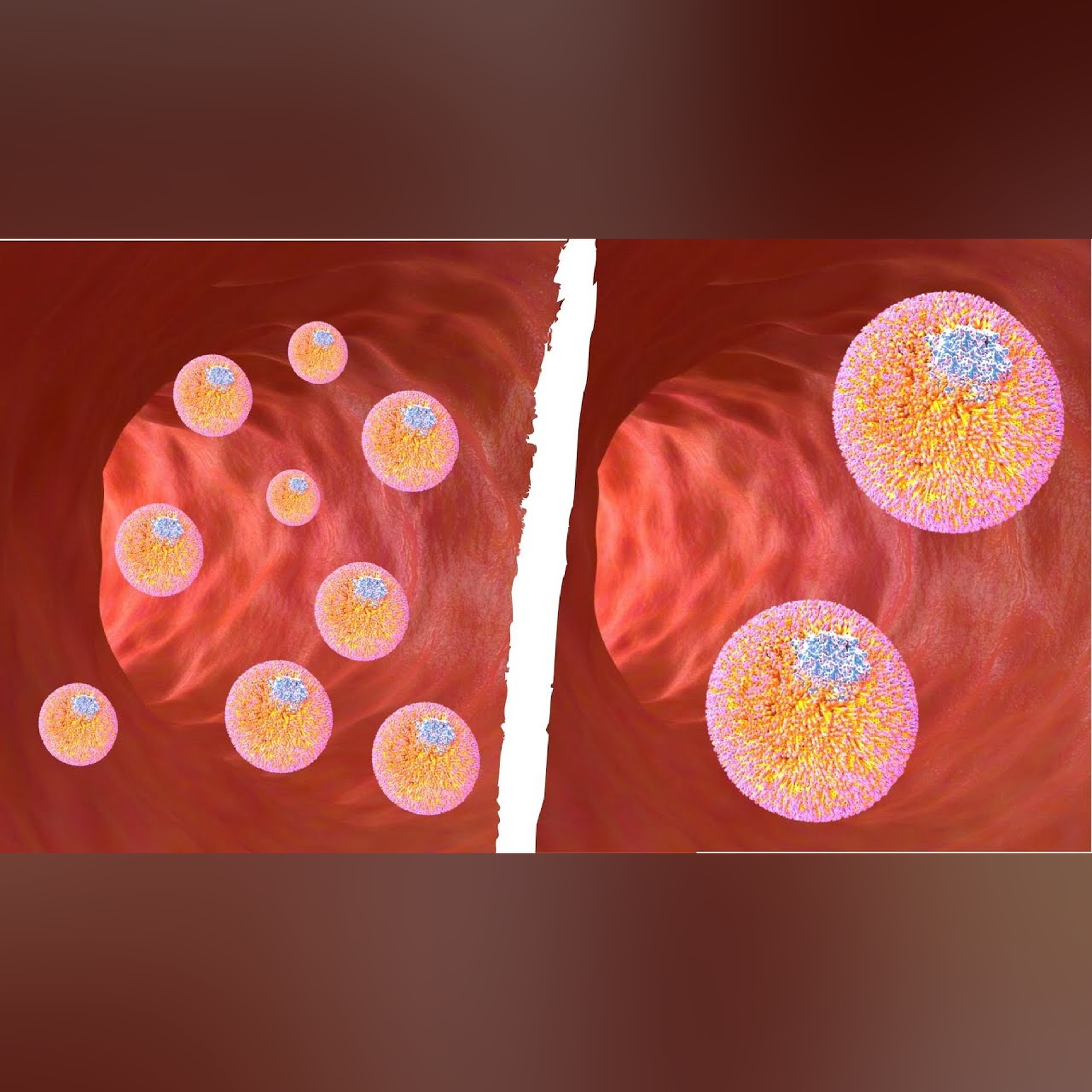 LDL particle size is a distraction | sdLDL vs particle number episode artwork