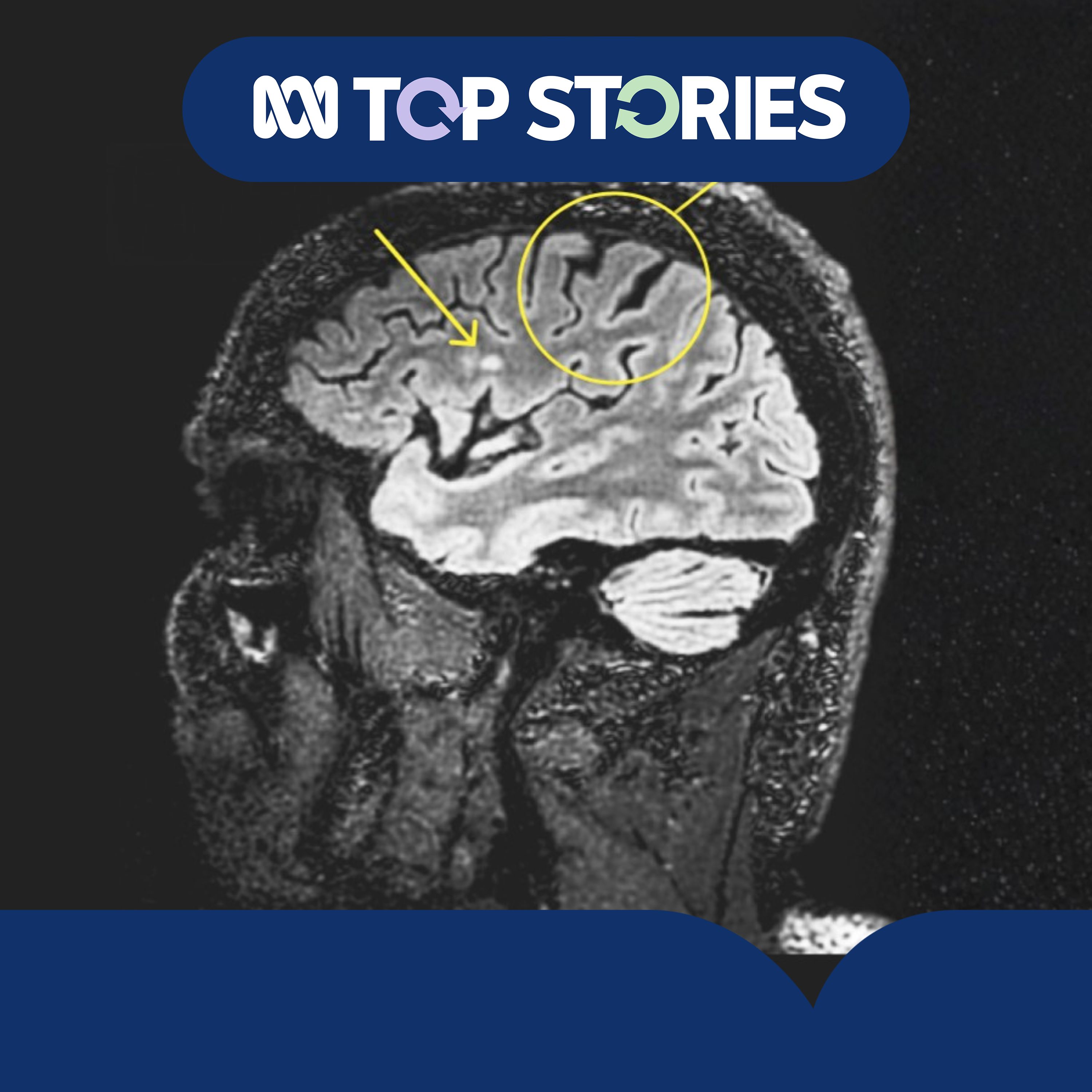 The degenerative brain disease CTE and rugby league explained episode artwork