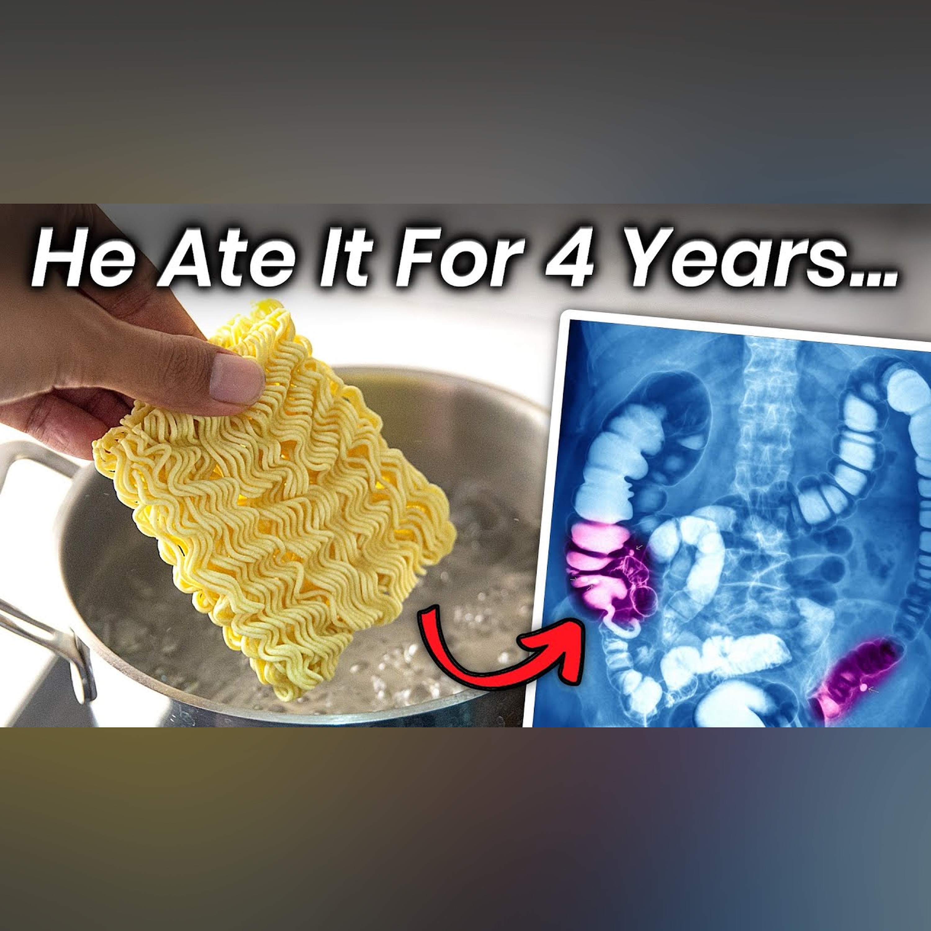 A Boy Ate Instant Noodles for 4 Years, This Is What Happened to His Stomach