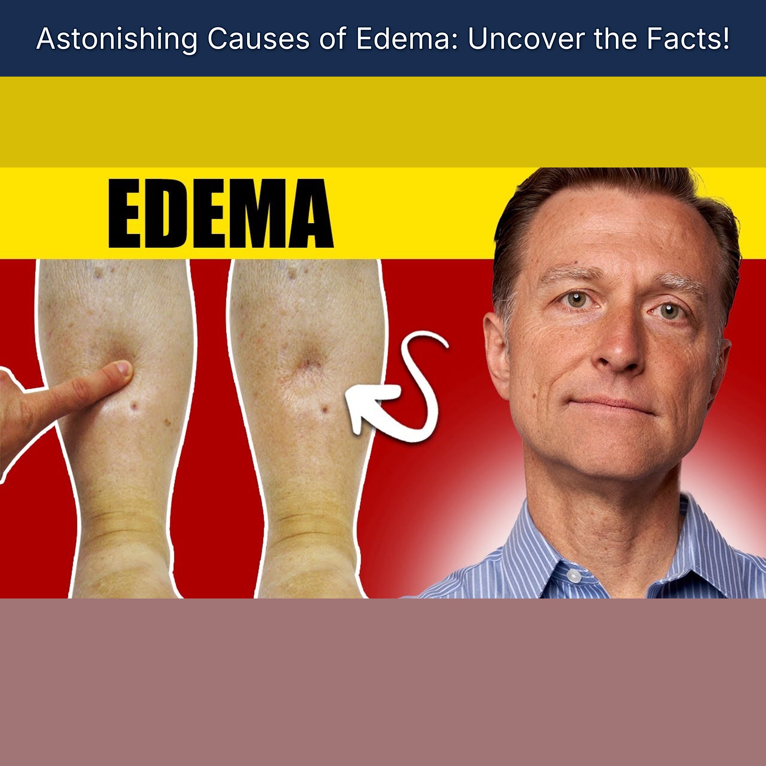 Astonishing Causes of Edema: Uncover the Facts!
