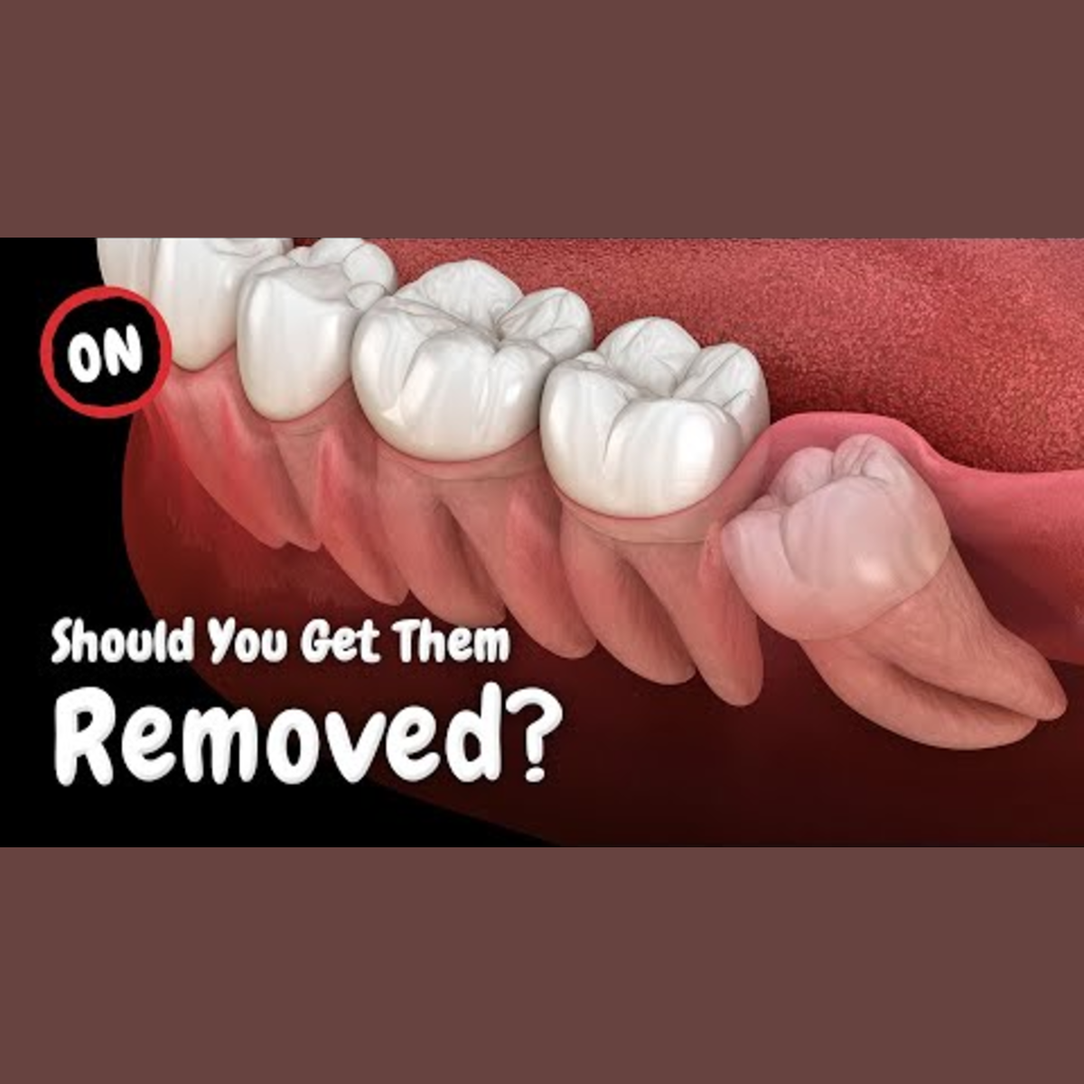 Discover Surprising Facts About Wisdom Teeth episode artwork