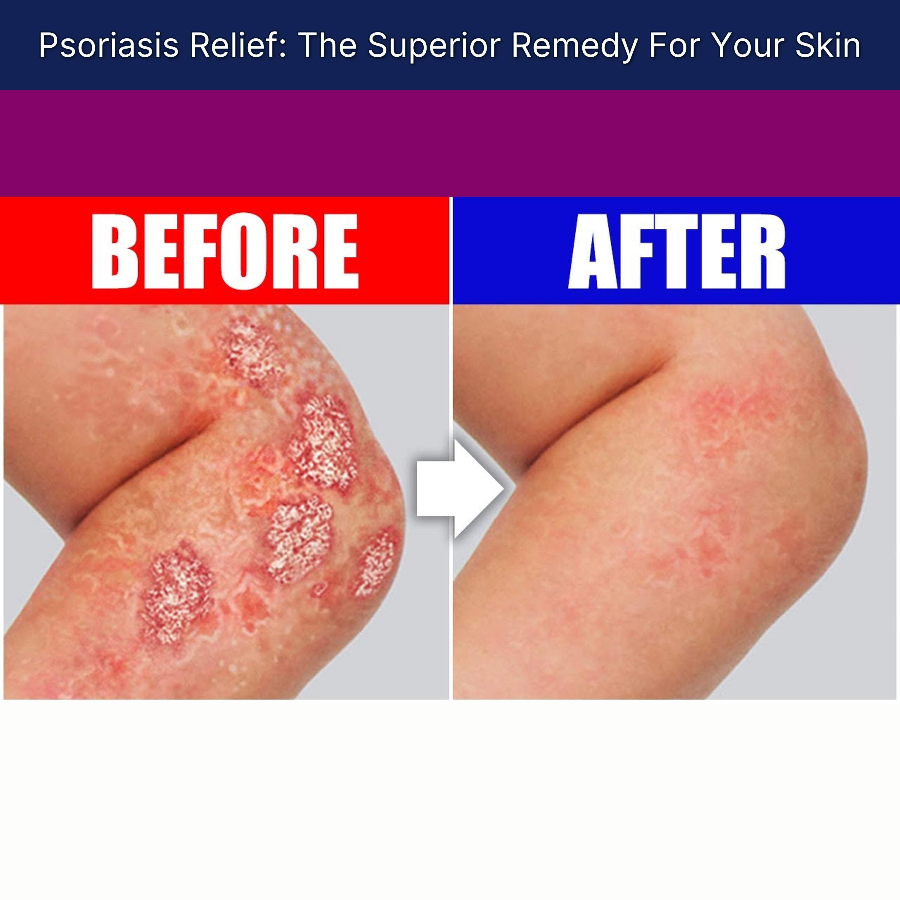 Psoriasis Relief: The Superior Remedy For Your Skin