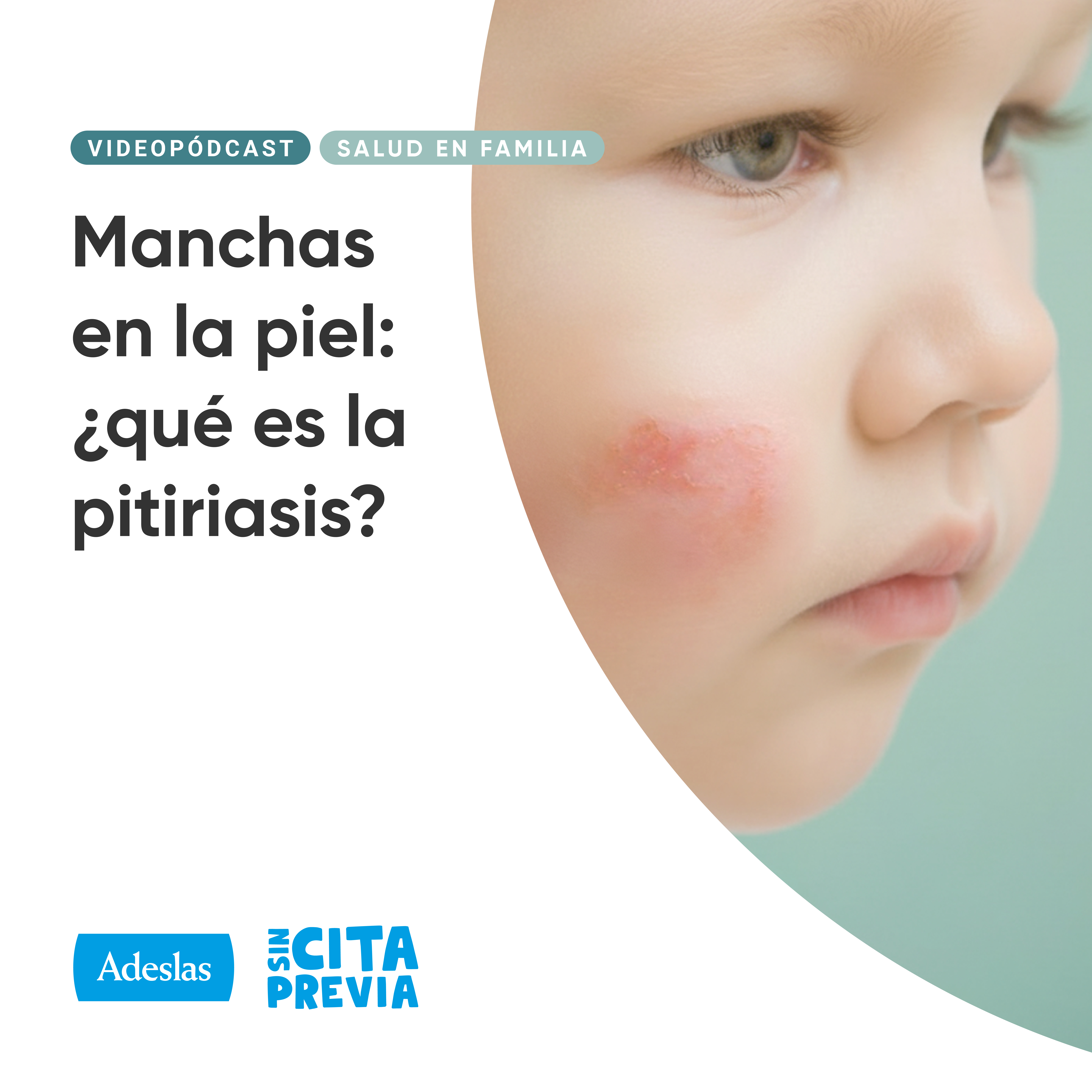 Manchas en la piel: ¿qué es la pitiriasis?