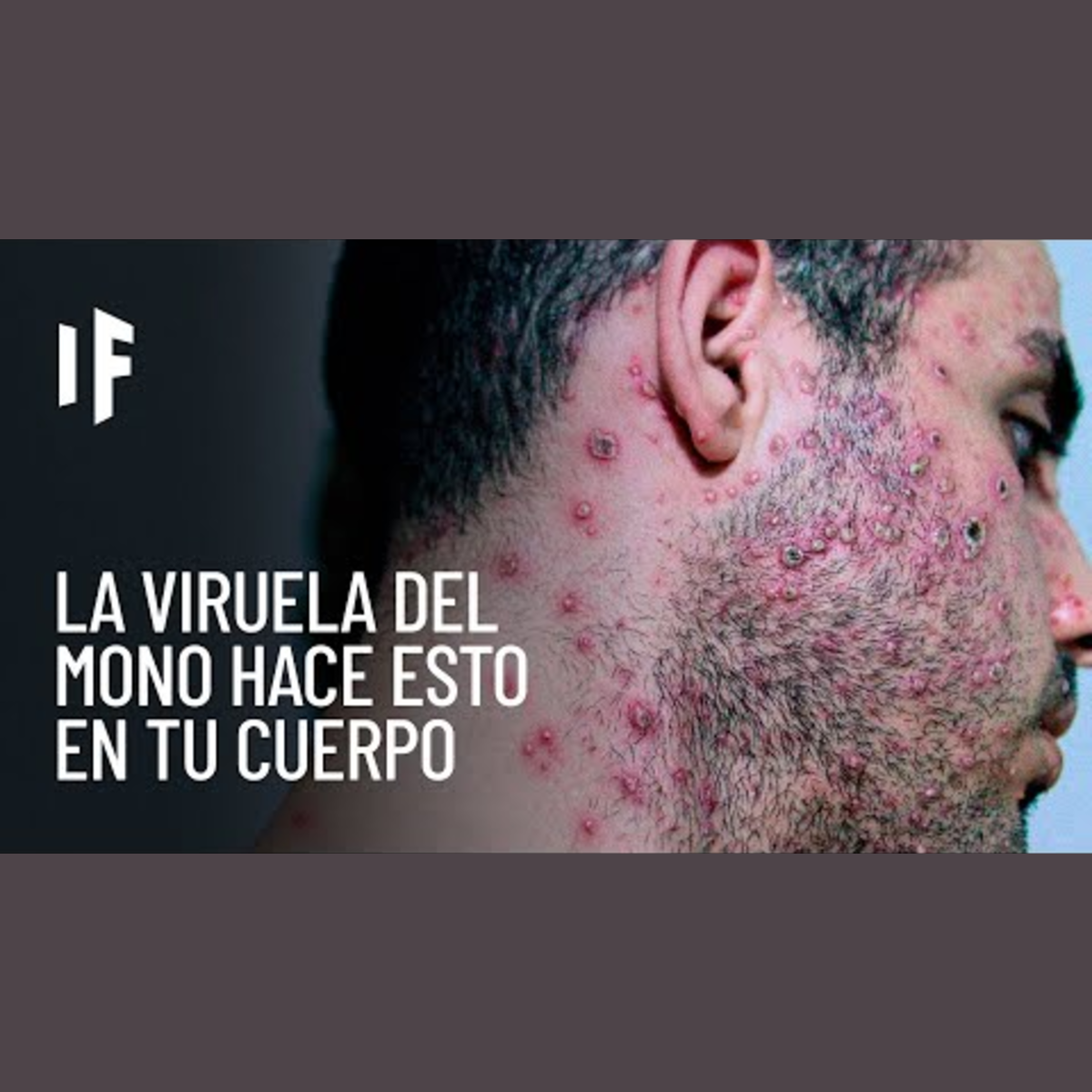 ¿Qué pasaría si contraes la viruela del mono o mpox? episode artwork