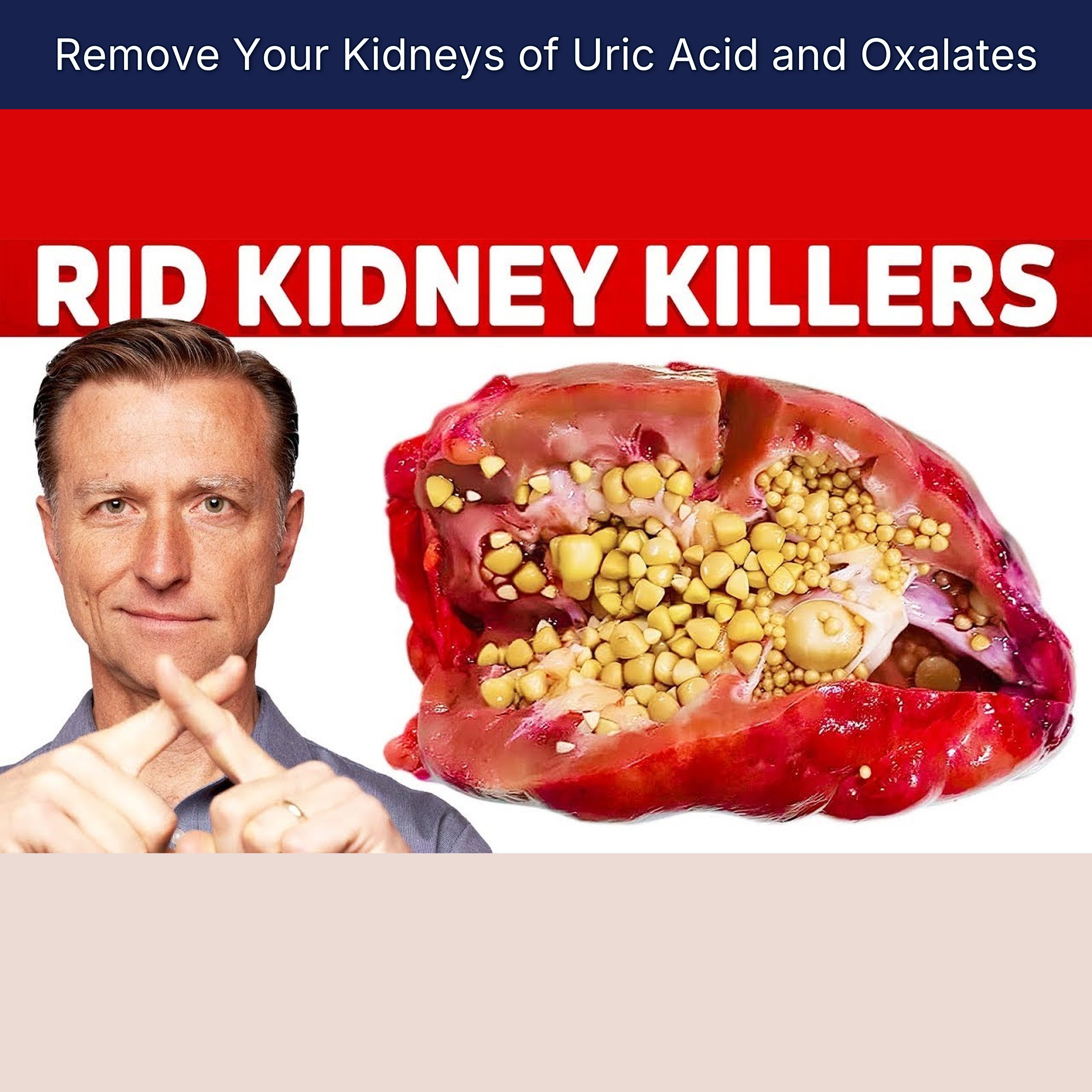 Remove Your Kidneys of Uric Acid and Oxalates